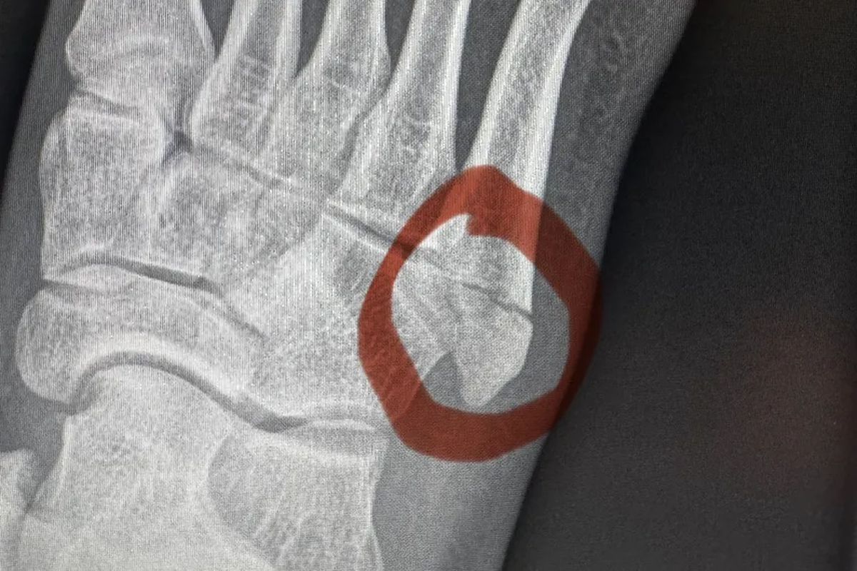 Снимок ноги Капе